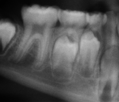 Endodontische Behandlung bei Kindern